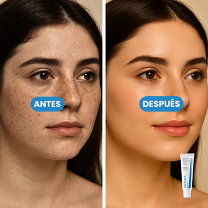 Sovana Acid Cream - Crema coreana para eliminar pacas y manchas