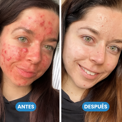 Sovana Bee - Crema para eliminar verrugas con Veneno de Abeja