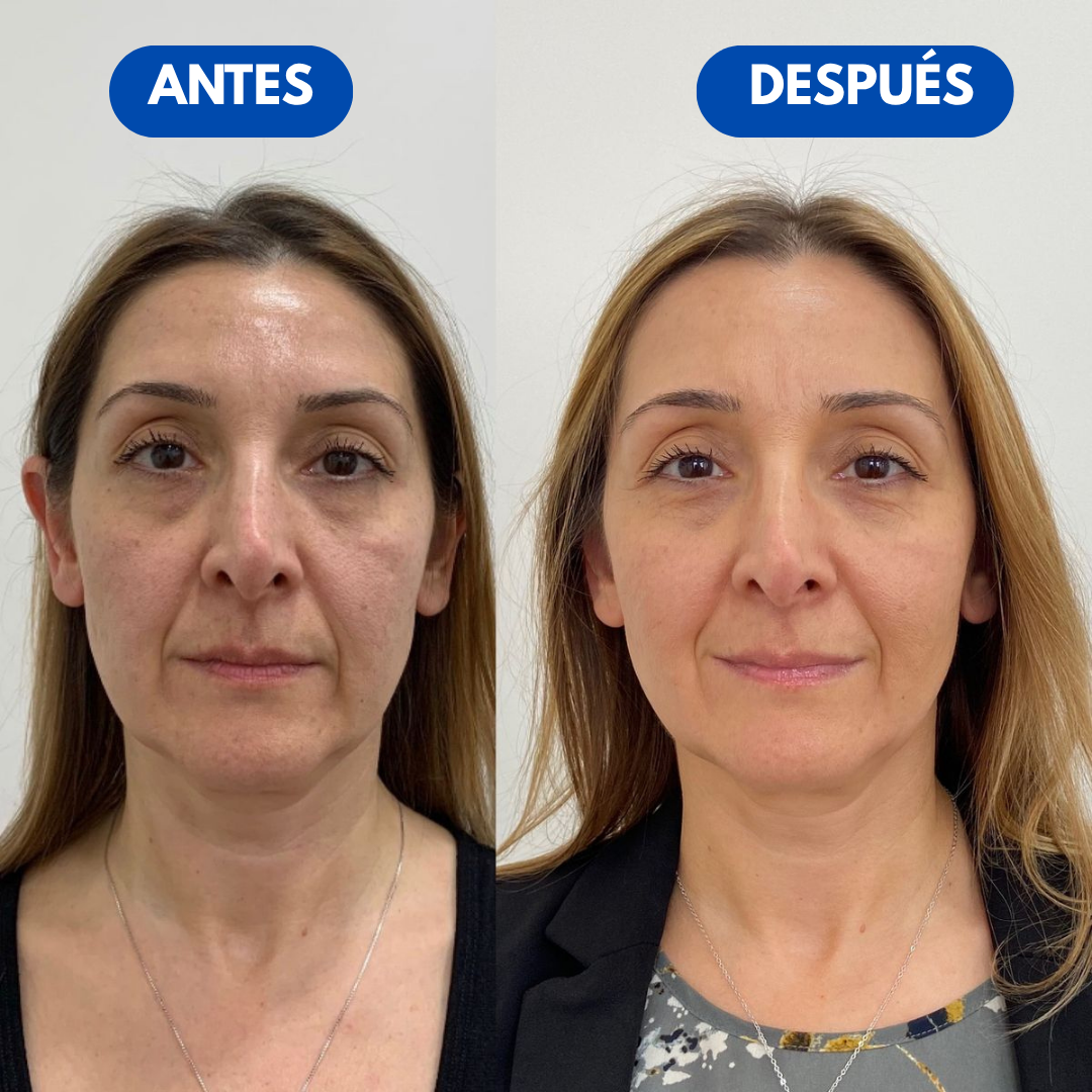 Sovana Peter Thomas™ - 2 Minutos. Cero Bolsas. 10 Años Menos.