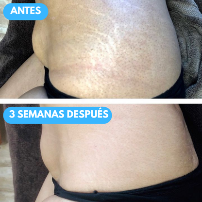 Sovana B Flat - Crema para el tratamiento de estrías