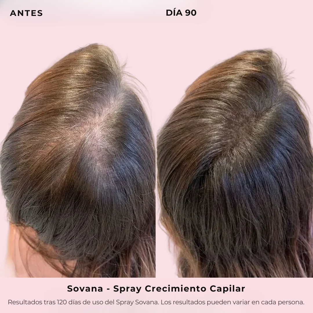 Sovana - Spray de Crecimiento Capilar
