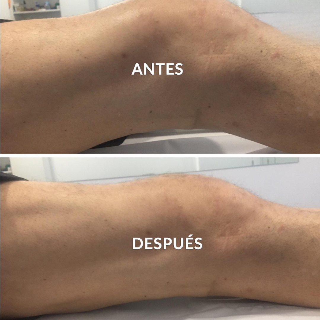 Sovana - Masajeador eléctrico para el dolor de rodilla