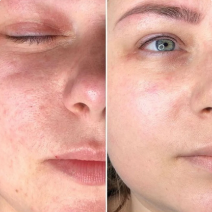 Erysse - Exfoliante coreano para una piel nueva en 3 minutos