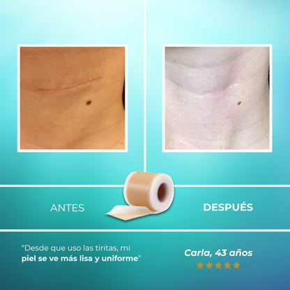 ScarTape - Tiras de silicona para hacer tus verrugas invisibles en segundos