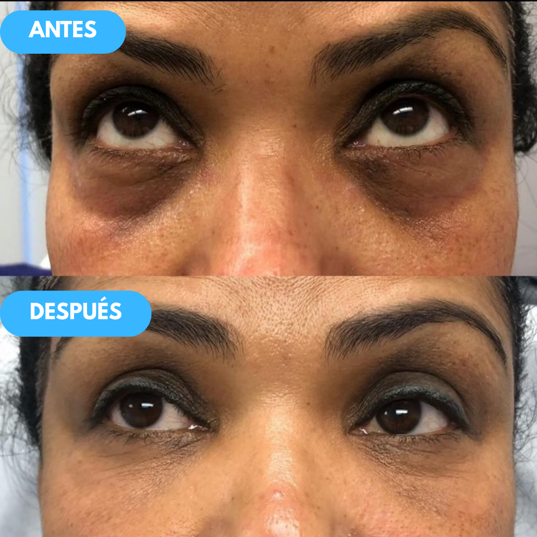 1+1 GRATIS| Nida™ - La solución definitiva para eliminar ojeras y bolsas del contorno de tus ojos